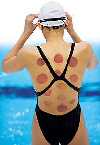 A nadadora chinesa Wang Qun com as marcas da terapia com ventosas